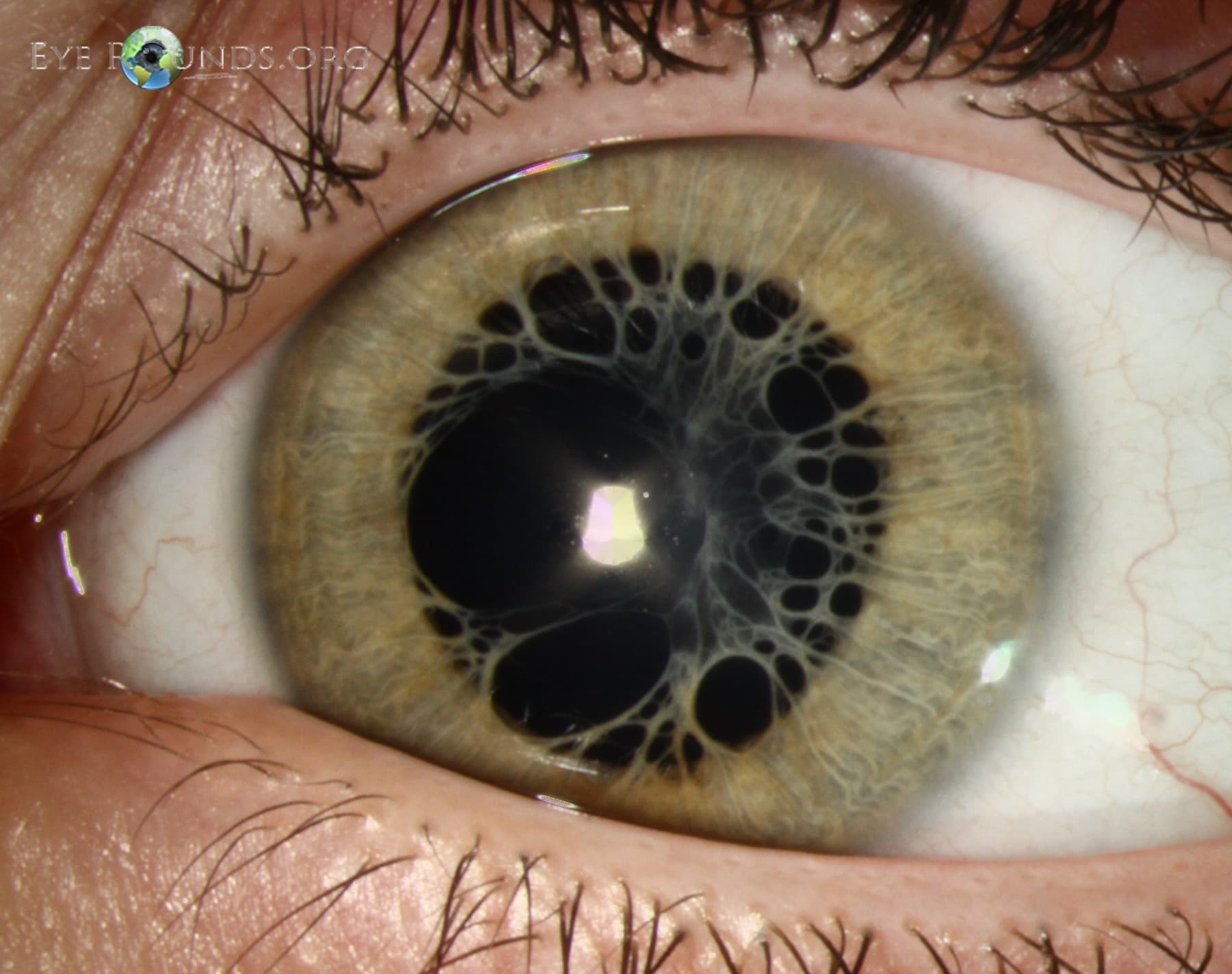 Clinical ophthalmic photograph of persistent pupillary membrane - iris condition