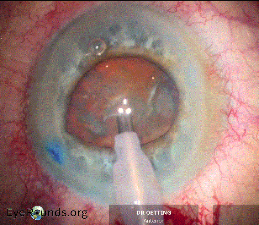 Clinical ophthalmic photograph of vitreous strand to paracentesis causing subtle peaked pupil early in case - iris condition