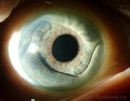 Clinical ophthalmic photograph of anterior chamber intraocular lens aciol restored - lens condition