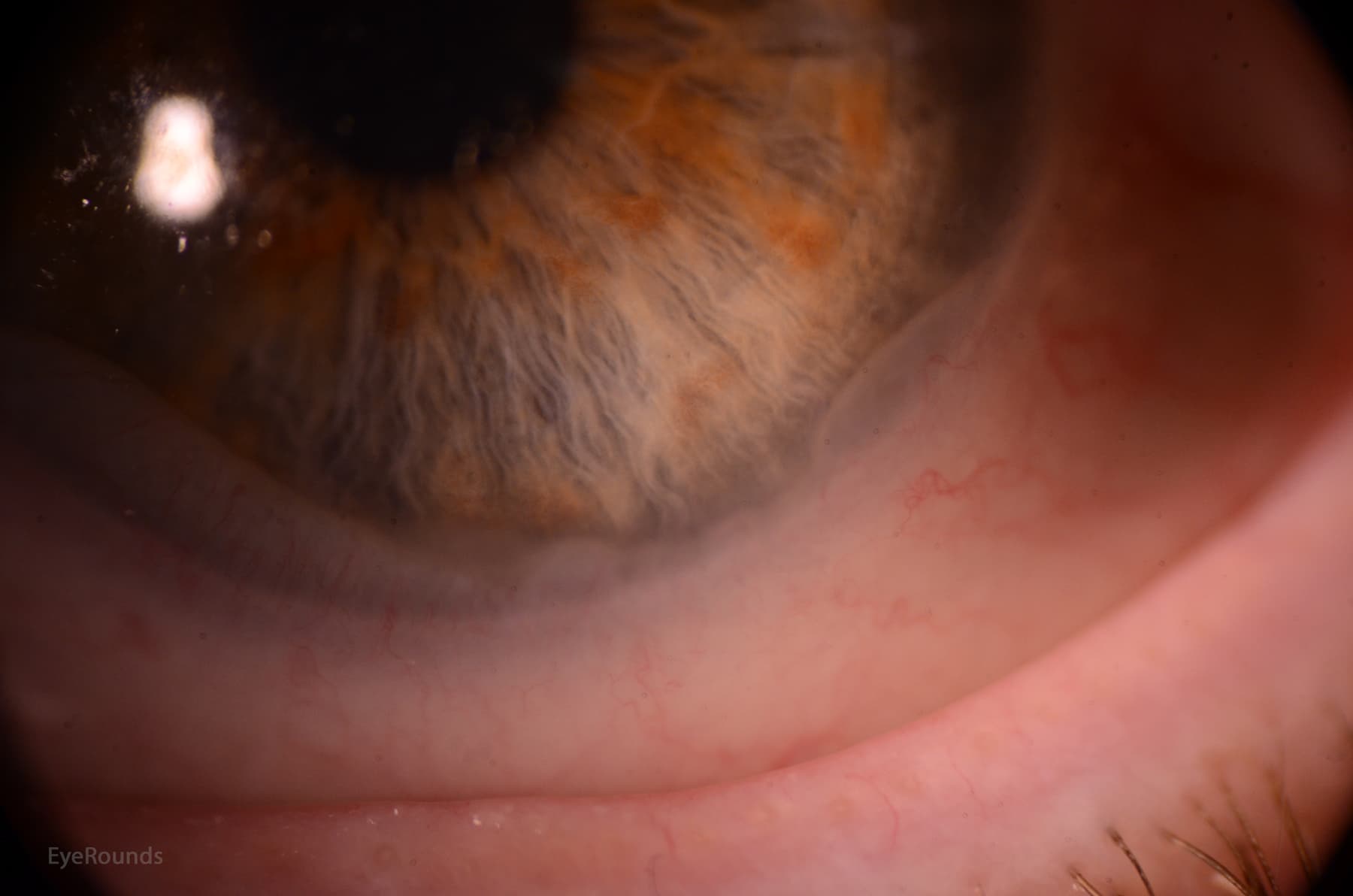 Clinical ophthalmic photograph of conjunctival prolapse under scleral contact lens - lens condition