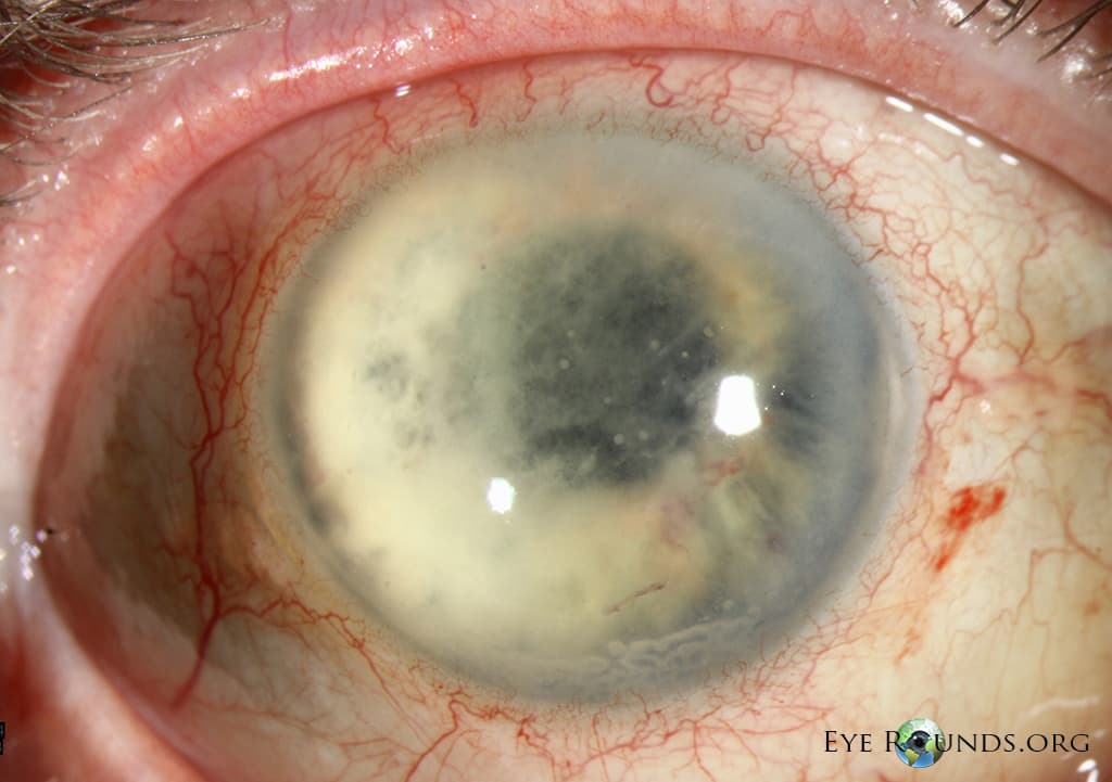 Clinical ophthalmic photograph of delayed postoperative fungal endophthalmitis - lens condition