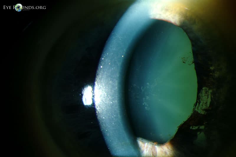 Clinical ophthalmic photograph of glaukomflecken and iris atrophy after acute angle closure glaucoma - lens condition