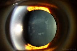 Clinical ophthalmic photograph of kayser fleischer ring in wilsons disease - lens condition