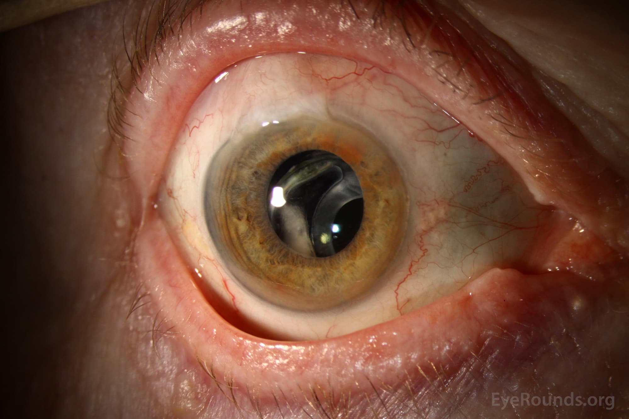 Clinical ophthalmic photograph of pseudoexfoliation syndrome - lens condition