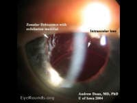 Clinical ophthalmic photograph of pseudoexfoliation zonular dehiscence - lens condition