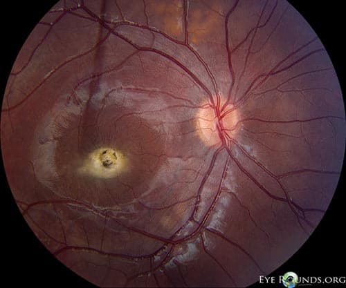 Clinical ophthalmic photograph of autosomal recessive best disease - neuro op condition