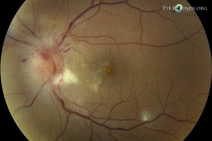 Clinical ophthalmic photograph of bartonella neuroretinitis - neuro op condition