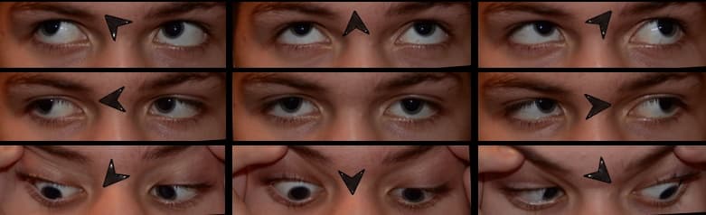 Clinical ophthalmic photograph of bilateral 4th nerve palsy - neuro op condition
