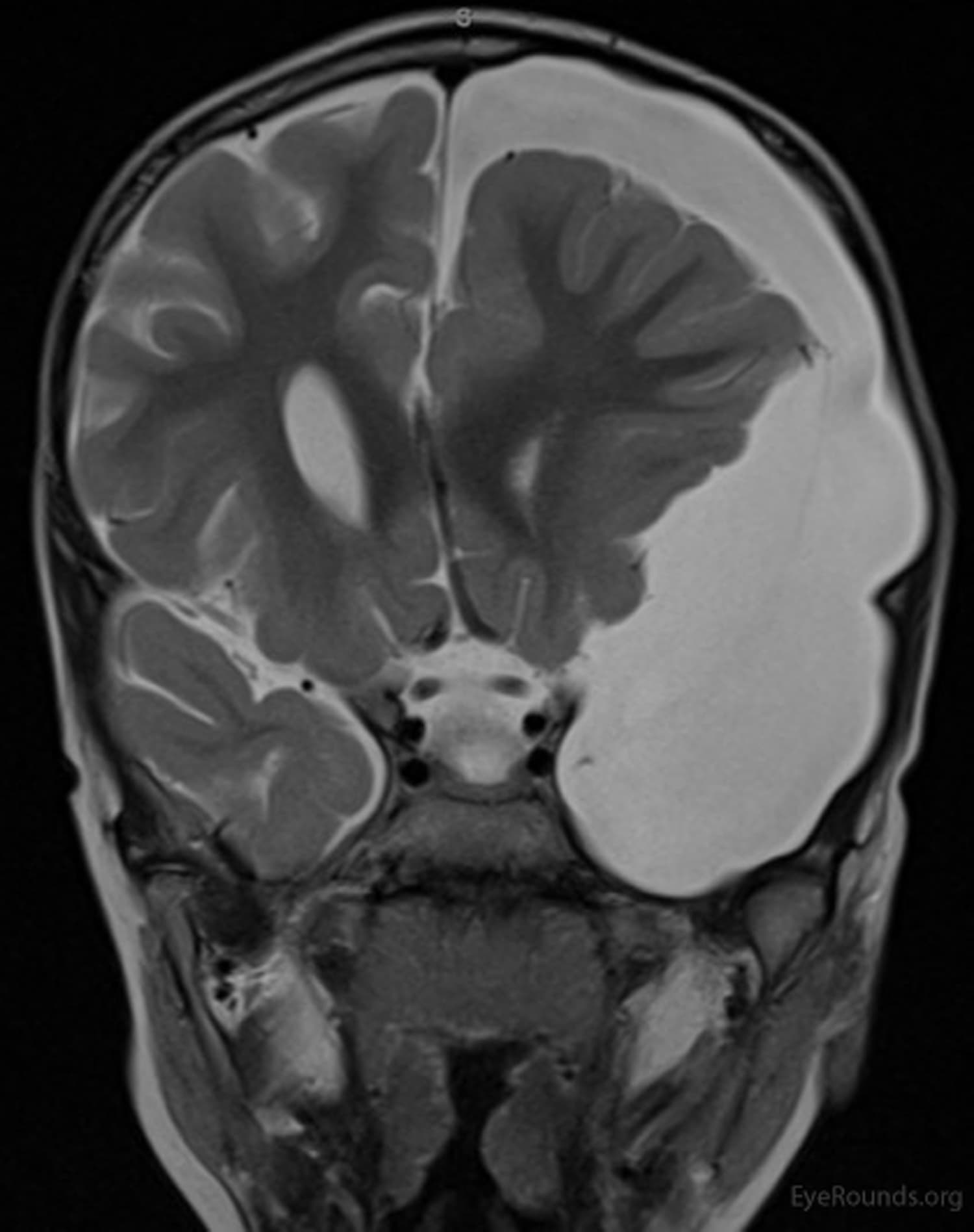 Clinical ophthalmic photograph of bilateral cranial nerve vi palsies secondary to arachnoid cyst - neuro op condition
