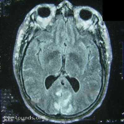 Clinical ophthalmic photograph of bilateral occipital infarcts stroke - neuro op condition