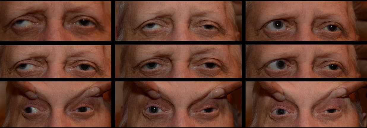 Clinical ophthalmic photograph of cavernous sinus syndrome - neuro op condition