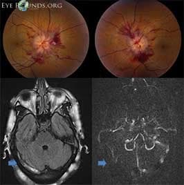 Clinical ophthalmic photograph of cerebral venous sinus thrombosis causing intracranial hypertension - neuro op condition