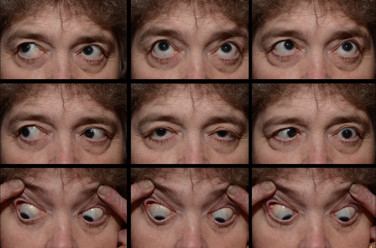 Clinical ophthalmic photograph of cranial nerve vi abducens nerve palsy secondary to schwannoma - neuro op condition