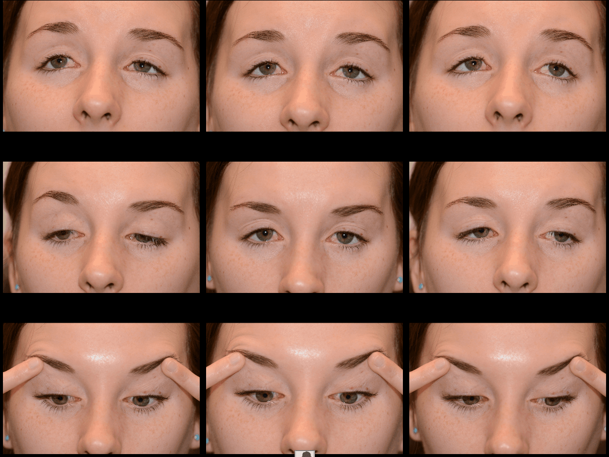 Clinical ophthalmic photograph of kearns sayre syndrome - neuro op condition