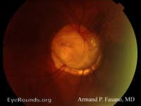 Clinical ophthalmic photograph of optic nerve coloboma with optic pits - neuro op condition