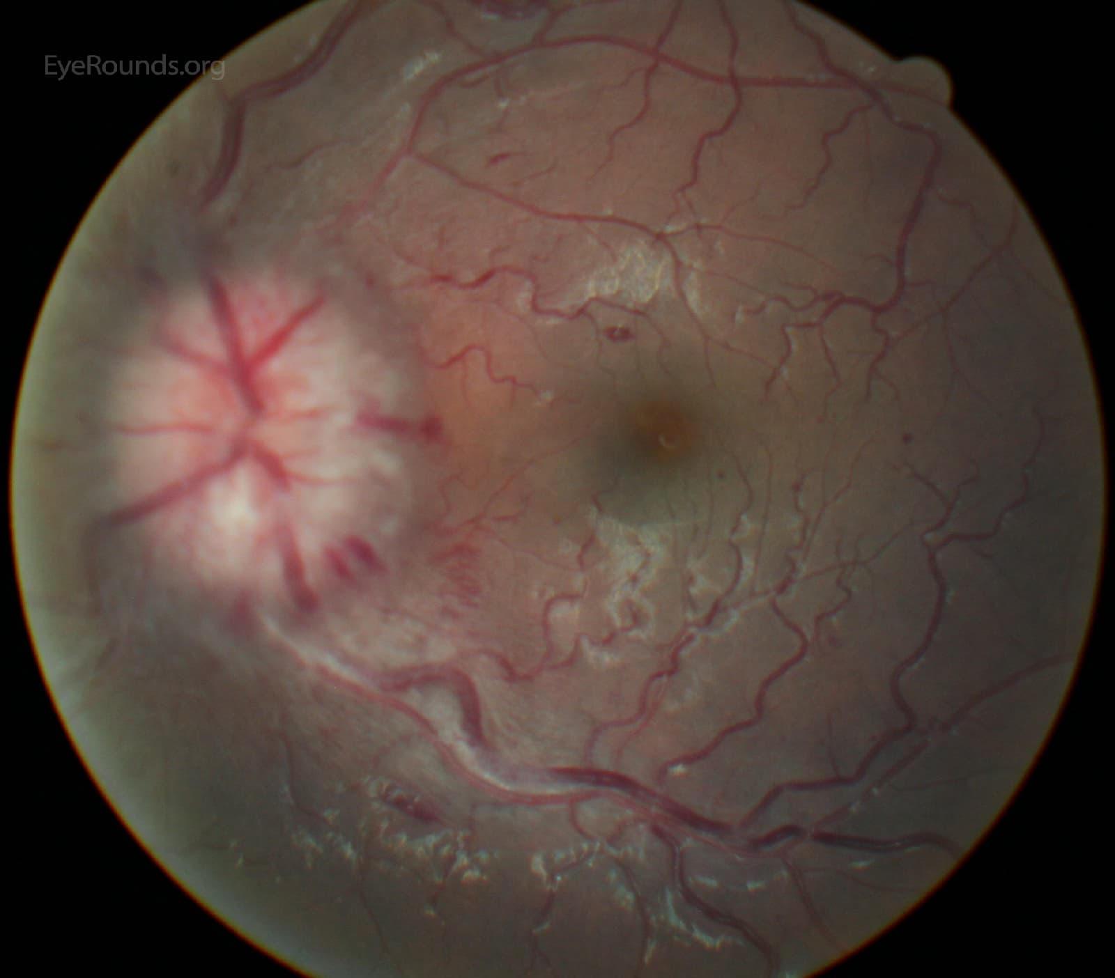 Clinical ophthalmic photograph of papilledema secondary to meningitis - neuro op condition