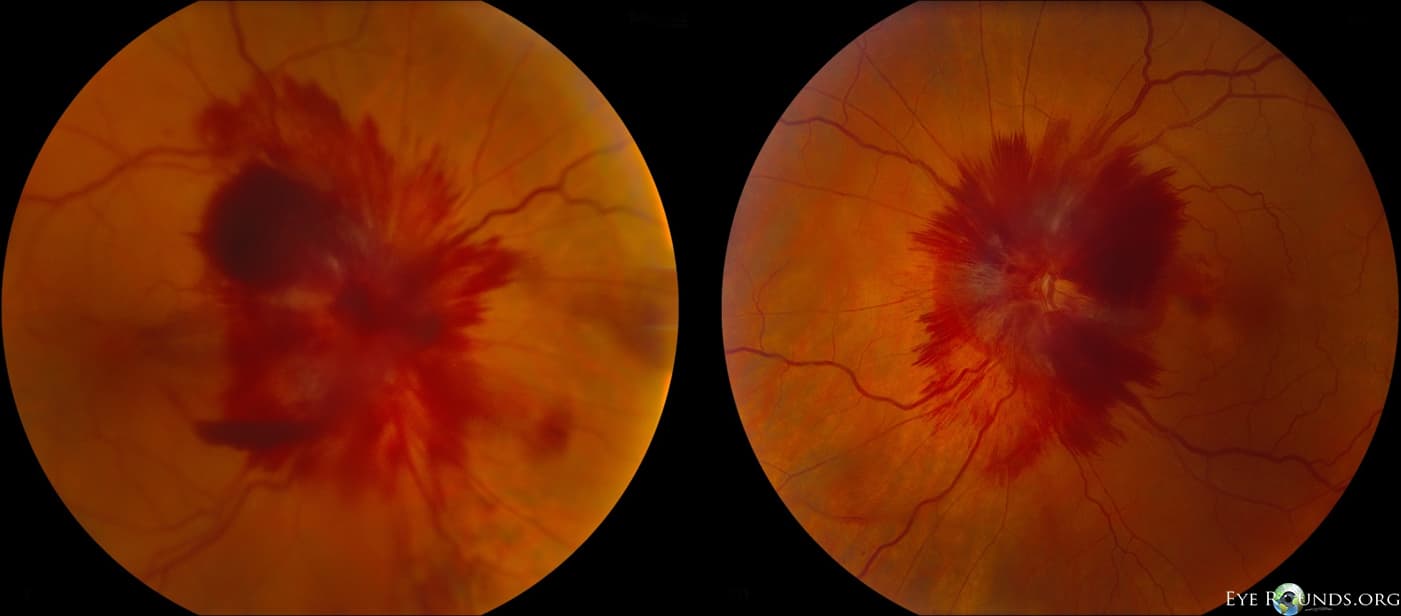 Clinical ophthalmic photograph of papilledema - neuro op condition