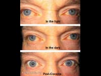 Clinical ophthalmic photograph of physiologic anisocoria - neuro op condition