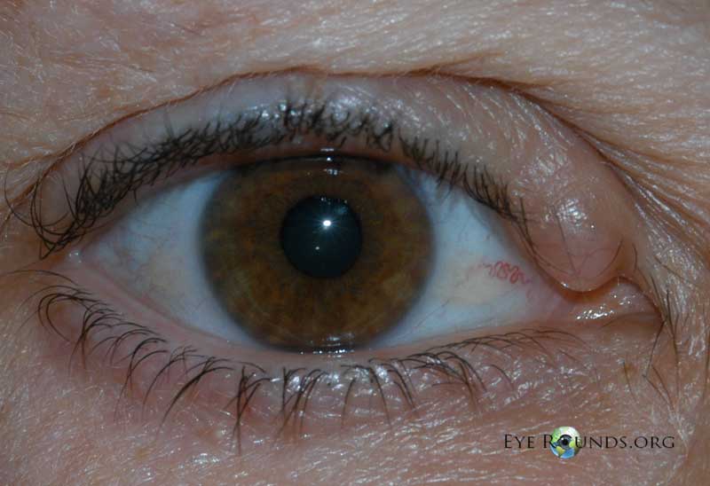 Clinical ophthalmic photograph of apocrine hidrocystoma - oculoplastics condition