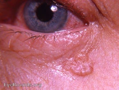 Clinical ophthalmic photograph of basal cell carcinoma - oculoplastics condition