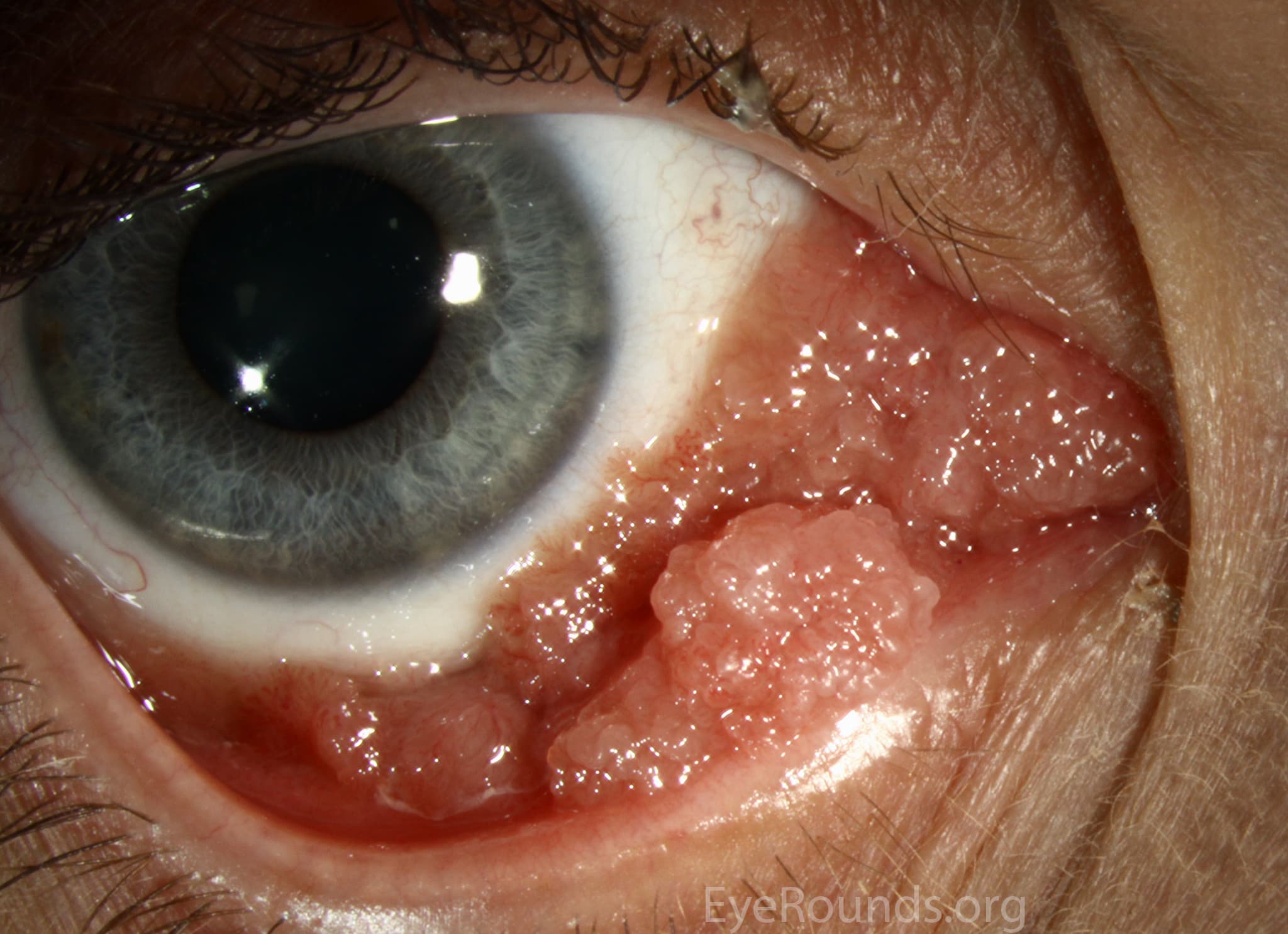 Clinical ophthalmic photograph of conjunctival papilloma - oculoplastics condition