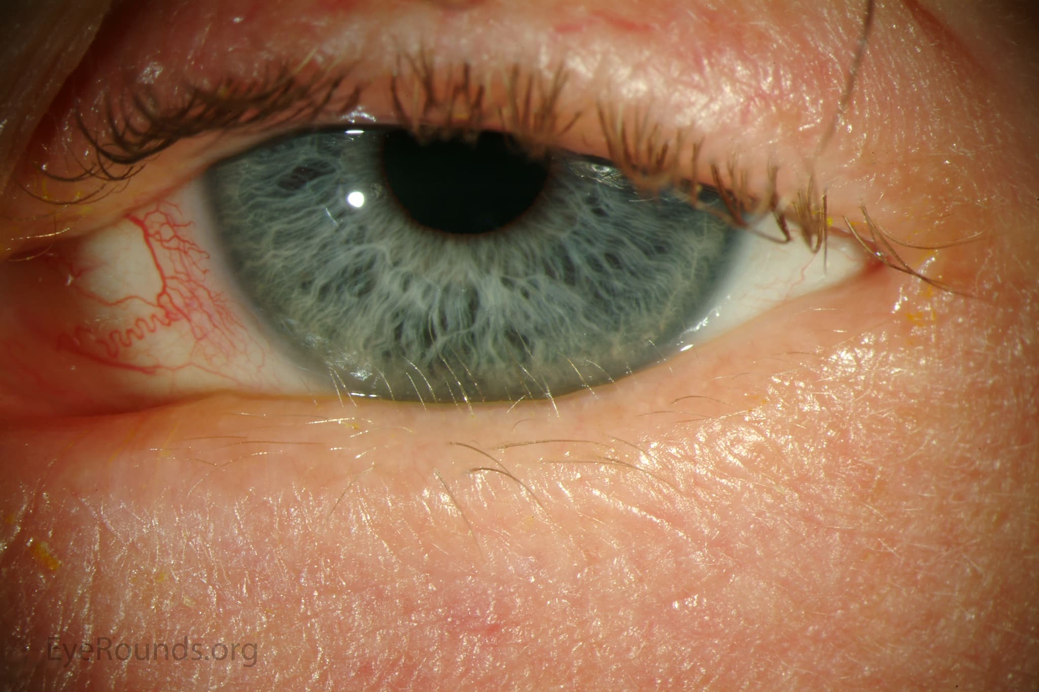 Clinical ophthalmic photograph of distichiasis - oculoplastics condition
