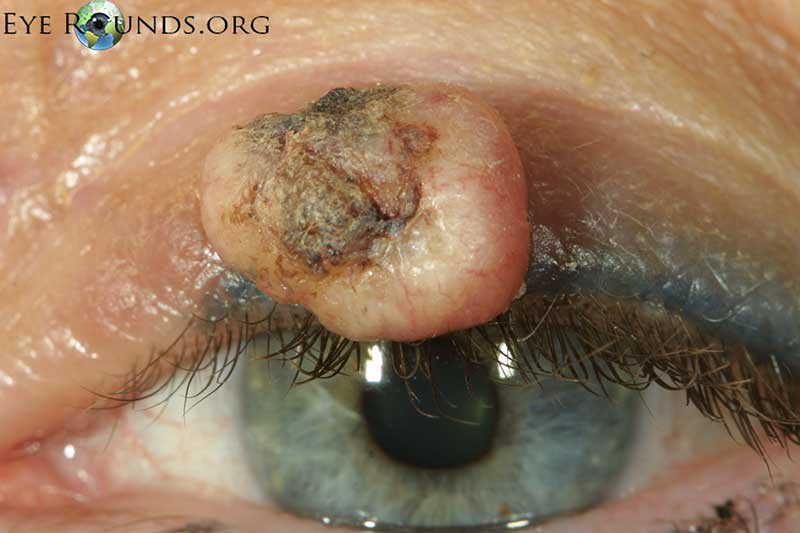 Clinical ophthalmic photograph of keratoacanthoma - oculoplastics condition