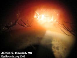 Clinical ophthalmic photograph of madarosis - oculoplastics condition