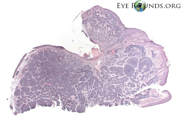 Clinical ophthalmic photograph of basal cell carcinoma nodular type - pathology condition