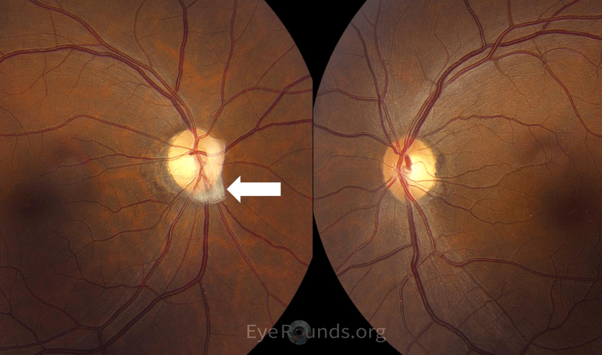Clinical ophthalmic photograph of bergmeister papilla - pathology condition