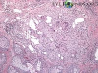 Clinical ophthalmic photograph of chalazion - pathology condition