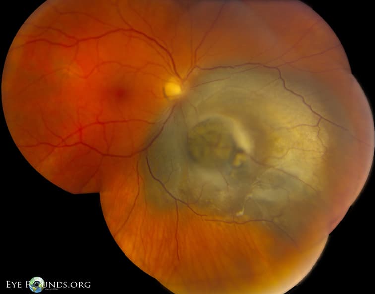 Clinical ophthalmic photograph of choroidal malignant melanoma in a "collar button" configuration - pathology condition