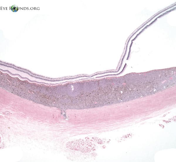 Clinical ophthalmic photograph of choroidal melanoma, histology - pathology condition