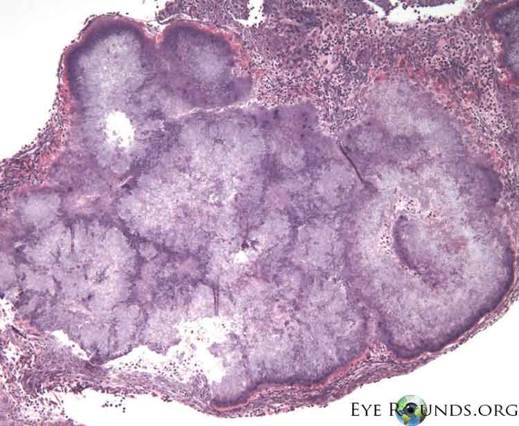 Clinical ophthalmic photograph of dacryolith due to actinomyces israelii - pathology condition