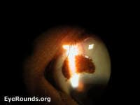 Clinical ophthalmic photograph of eyerounds online atlas of ophthalmology - pathology condition