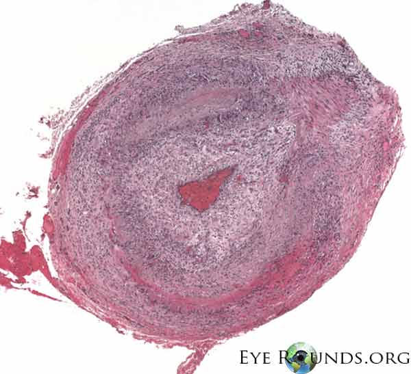 Clinical ophthalmic photograph of giant cell arteritis - pathology condition