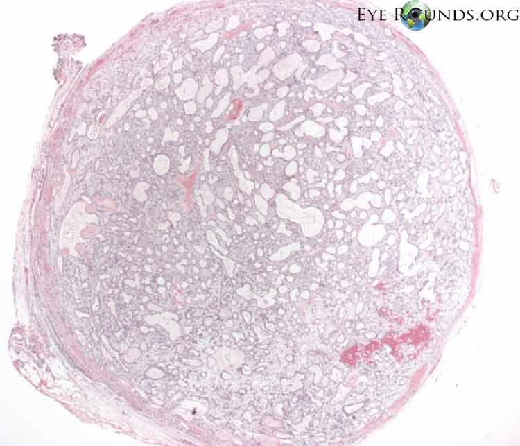 Clinical ophthalmic photograph of pleomorphic adenoma - pathology condition