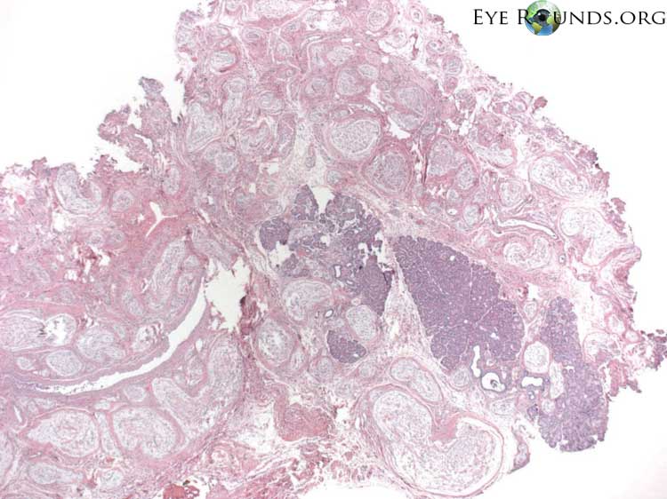 Clinical ophthalmic photograph of plexiform neurofibroma - pathology condition