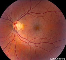 Clinical ophthalmic photograph of acute macular neuroretinopathy amn restored - retina condition