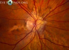 Clinical ophthalmic photograph of angioid streaks - retina condition