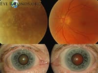 Clinical ophthalmic photograph of asteroid hyalosis - retina condition