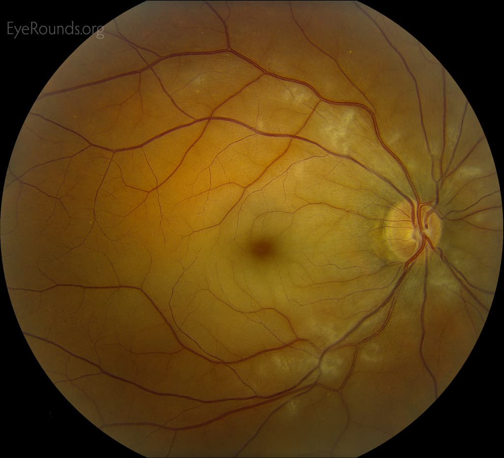 Clinical ophthalmic photograph of central retinal artery occlusion crao - retina condition