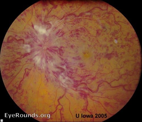 Clinical ophthalmic photograph of central retinal vein occlusion crvo - retina condition