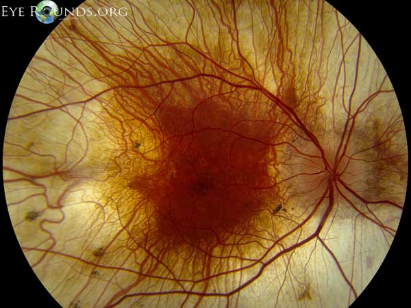 Clinical ophthalmic photograph of choroideremia - retina condition