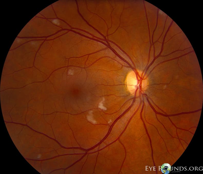Clinical ophthalmic photograph of cytomegalovirus cmv retinitis - retina condition