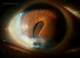 Clinical ophthalmic photograph of adherent leukoma and epithelial inclusion cyst after penetrating trauma - trauma condition