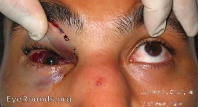 Clinical ophthalmic photograph of blowout fracture, upgaze restriction - trauma condition