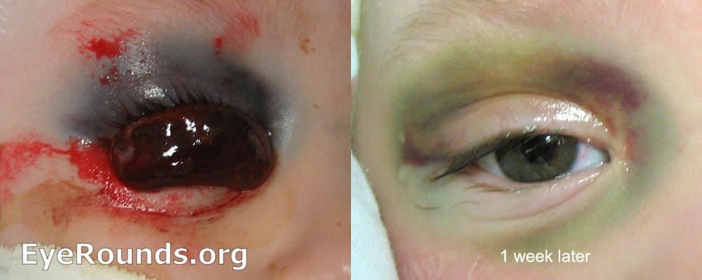 Clinical ophthalmic photograph of bullous subconjunctival hemorrhage from orbital roof fracture - trauma condition
