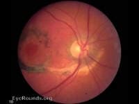 Clinical ophthalmic photograph of choroidal rupture - trauma condition