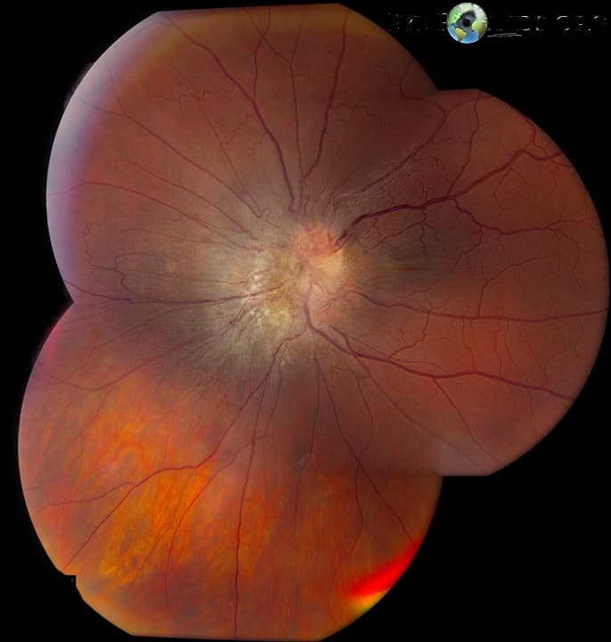 Clinical ophthalmic photograph of combined hamartoma of the retina and rpe, peri papillary - trauma condition